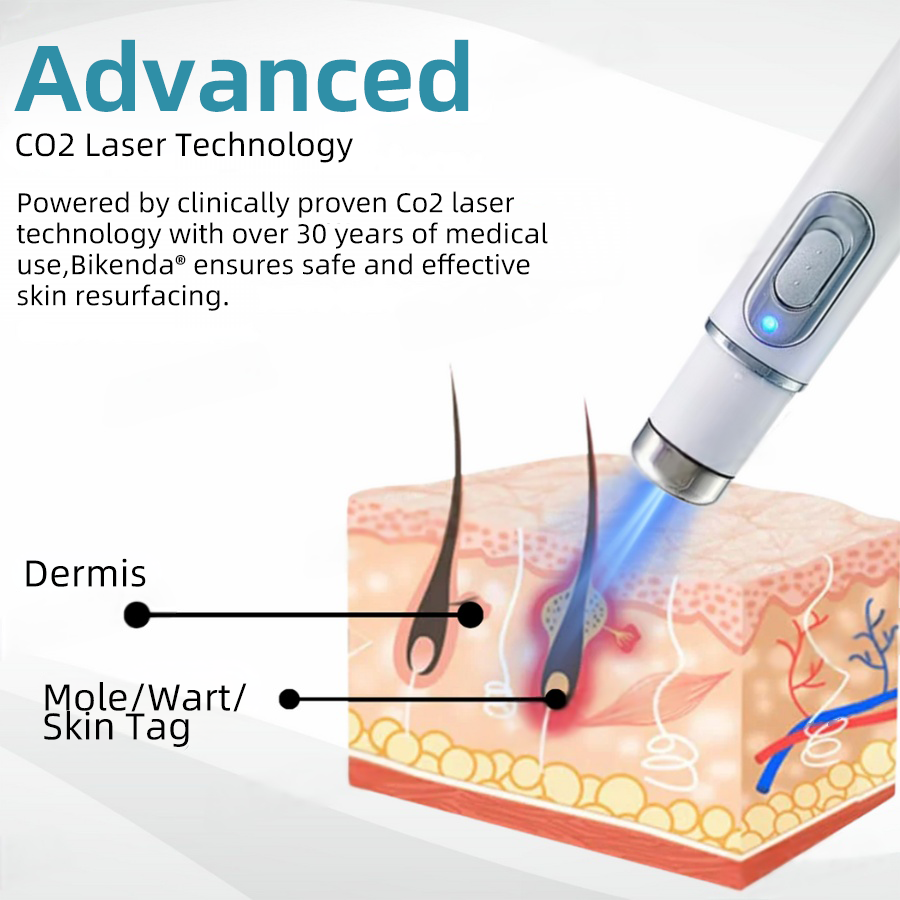 Vermoila® Nicht-invasive Laser-Stift Promax zur Entfernung von Muttermalen und Warzen