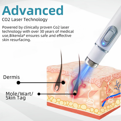 Vermoila® Nicht-invasive Laser-Stift Promax zur Entfernung von Muttermalen und Warzen