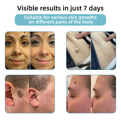 Vermoila® Nicht-invasive Laser-Stift Promax zur Entfernung von Muttermalen und Warzen