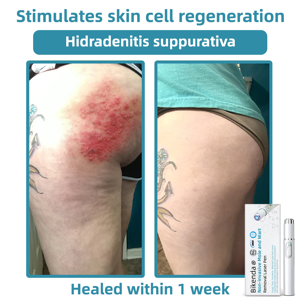 Vermoila® Nicht-invasive Laser-Stift Promax zur Entfernung von Muttermalen und Warzen