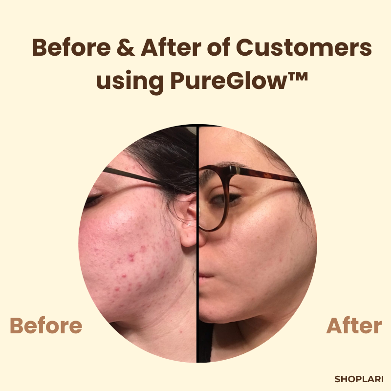 Letzter Tag – 1+1 GRATIS!🔥 PureGlow™ Schwarztee-Maske