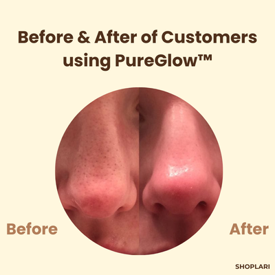 Letzter Tag – 1+1 GRATIS!🔥 PureGlow™ Schwarztee-Maske